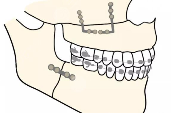 廣大雙頜手術(shù)怎么樣