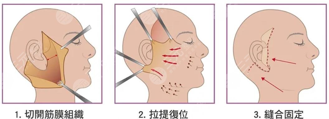 北京大學(xué)第三醫(yī)院割雙眼皮手術(shù)怎么樣