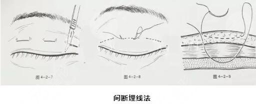  Anshan Qimin Beauty Hospital How about double eyelids