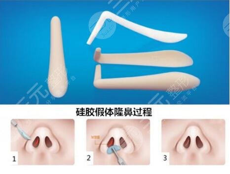  How about augmentation rhinoplasty in Guangzhou Strait Plastic Hospital