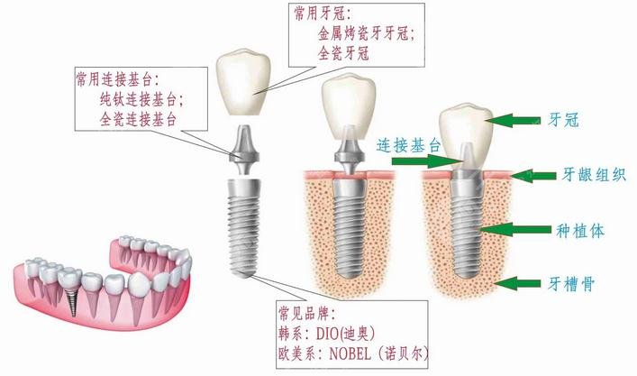 惠州人民医院种牙科收费标准是怎样的