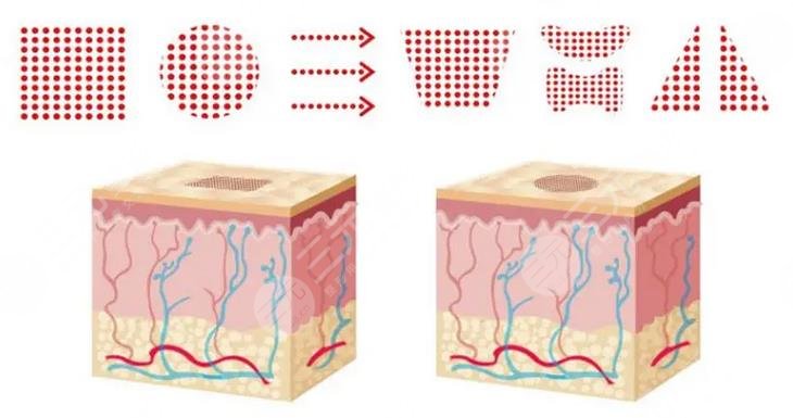  Does the dot matrix laser work well in Dongguan People's Hospital