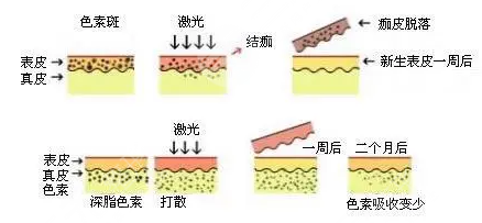 東莞人民醫(yī)院皮膚科激光是怎樣的