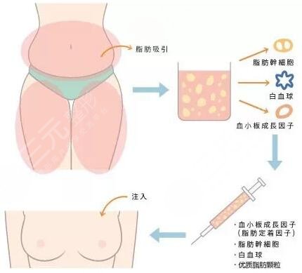 深圳大学总医院脂肪填充怎样