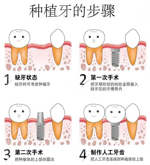 上海五院种植牙怎么样
