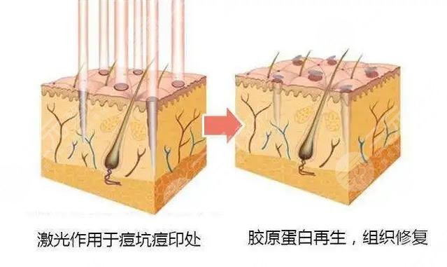 哈医大一院点阵激光做的好不好