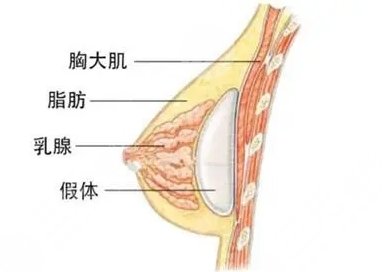 中山二院有隆胸吗