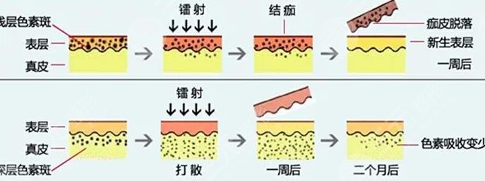 南方医科大学深圳医院激光祛斑价格高吗