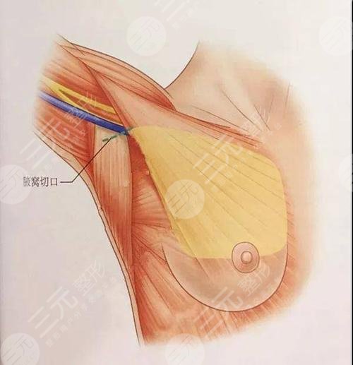 米兰柏羽医学美容医院丰胸怎么样