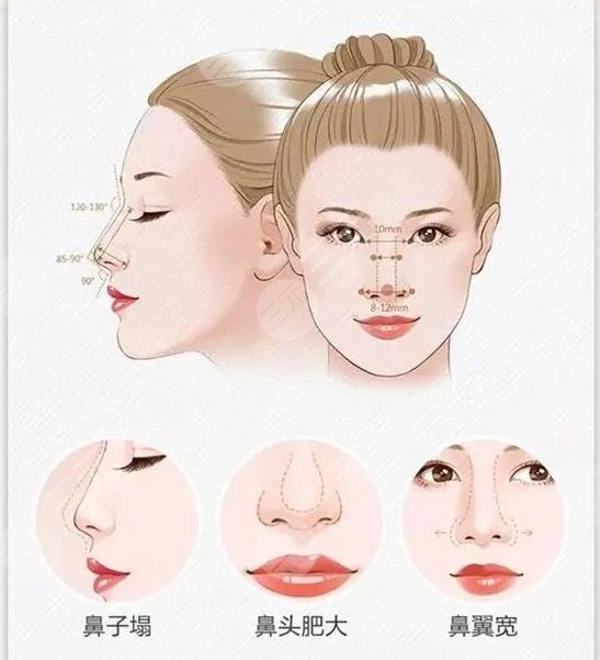  How about Maoming People's Hospital plastic surgery Cologne nose