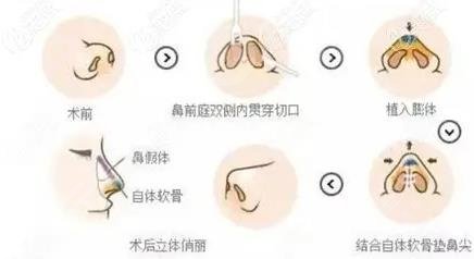  How about Maoming People's Hospital plastic surgery Cologne nose