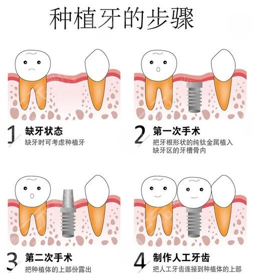 闵行区中心医院种牙技术怎么样