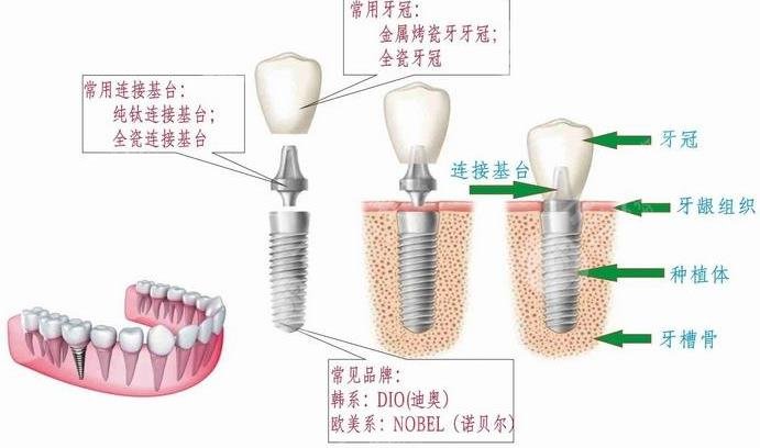 寶安人民醫(yī)院種牙的技術(shù)怎么樣