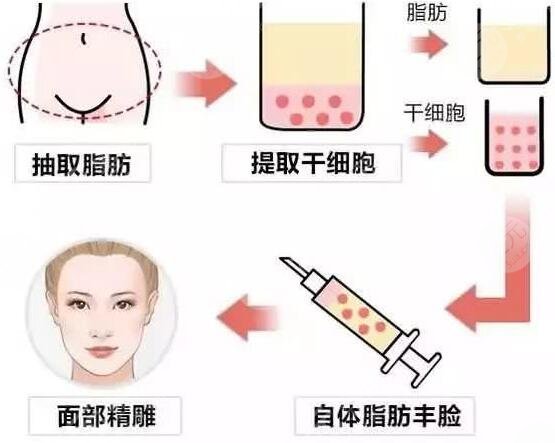  How about fat filling in Hebei Second Hospital