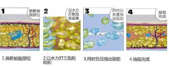 綿陽中心醫(yī)院面部吸脂的技術(shù)怎么樣