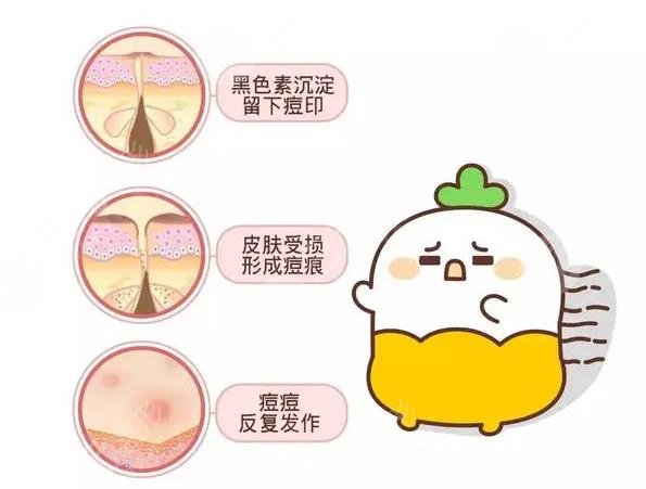  How about laser acne removal printing in Peking University Shenzhen Hospital