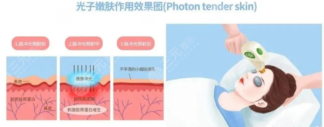  How about the effect of photo rejuvenation in Nanchang Second Affiliated Hospital