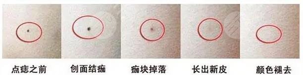  How about the plastic surgery of the Affiliated Hospital of Chengdu University to remove moles