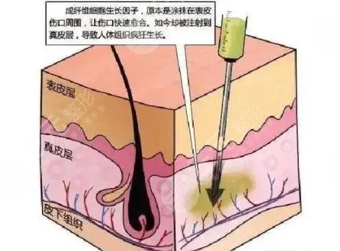 广州荔湾医院取生长因子怎么样