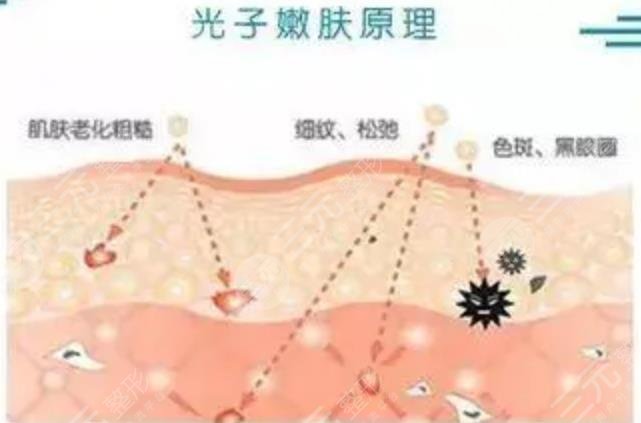  How much is the quotation of Quzhou People's Hospital Photorejuvenation