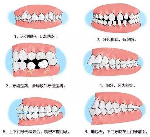 深圳第二人民医院牙齿矫正多少钱