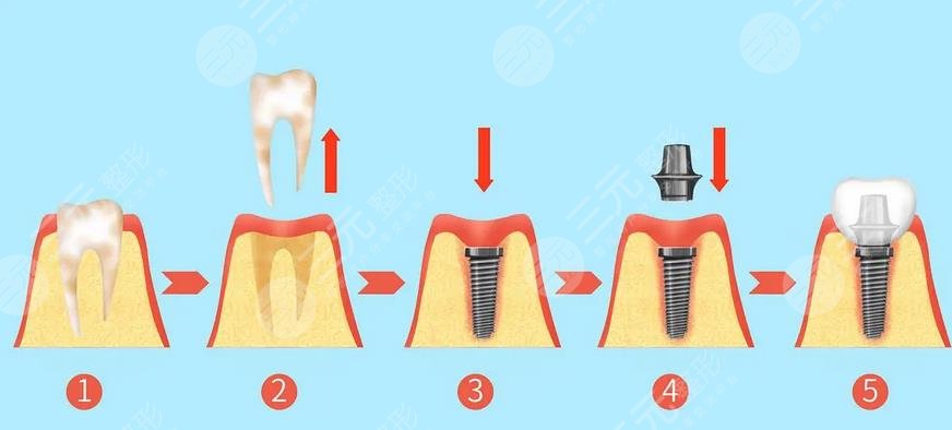  How about the technical operation of dental implant in Dongguan People's Hospital