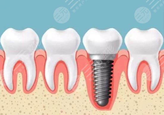  What are the dental implant series of Shenzhen Second People's Hospital