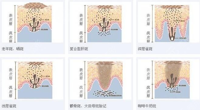  How about freckle removal in the dermatology department of Chengdu Second People's Hospital