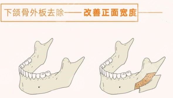 北京八大处磨骨哪个医生好