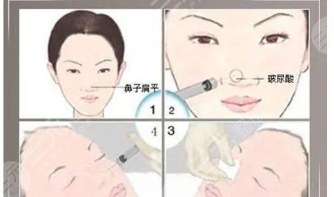  Which doctor is better for nose augmentation in Jiuyuan Hospital