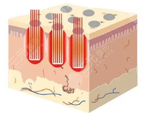  Is dot matrix laser good in Fuyang Dermatology Hospital