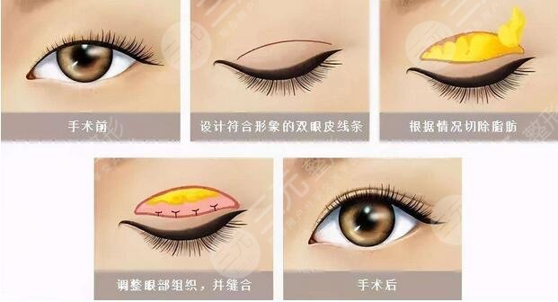  How about Shantou First Affiliated Doctor's double eyelids