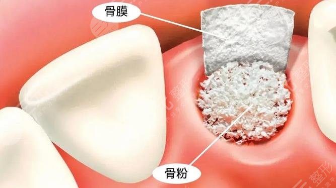  How about dental implant in Zhongshan People's Hospital