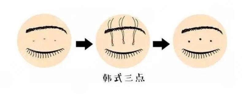  How about a double eyelid operation in Dongying Central Hospital