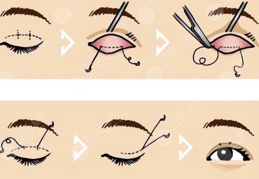  How about double eyelid surgery in Chengdu Second People's Hospital