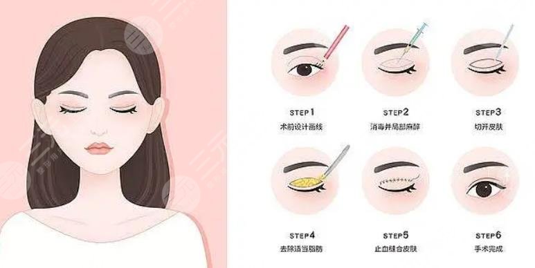  How about double eyelid surgery in Chengdu Second People's Hospital