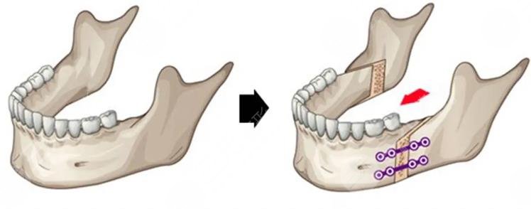  How about orthognathic surgery in the department of stomatology of Jiangmen Central Hospital