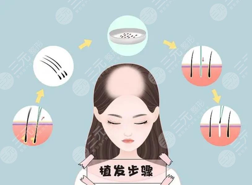  How about the Hair Transplantation Center of the Second Affiliated Hospital of Zhengzhou University