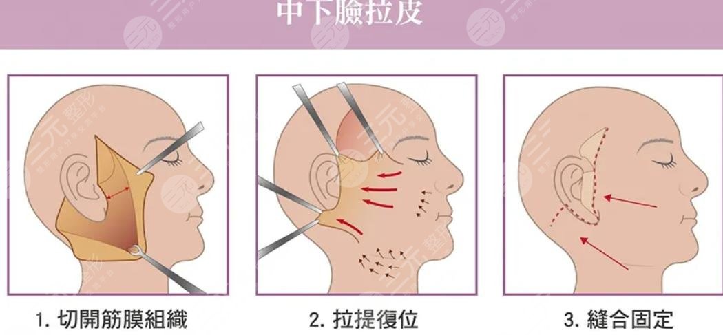 45歲適合做小拉皮還是大拉皮