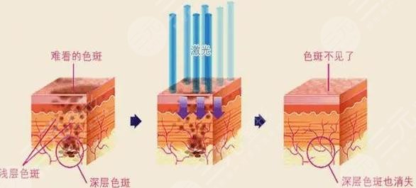 吉大二院點陣激光價格是多少