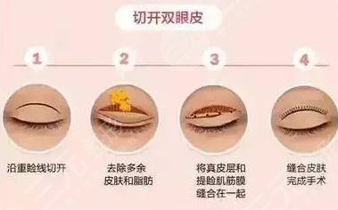  How much is the double eyelid of Xiaolan People's Hospital