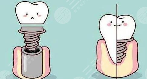  The price of dental implants in the First Hospital of Medical University was exposed