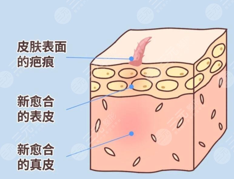 像素激光去疤痕要做多少次才能好有效果