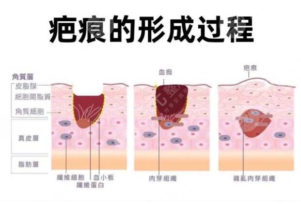 像素激光去疤痕要做多少次才能好有效果