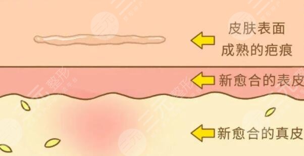 像素激光去疤痕要做多少次才能好有效果