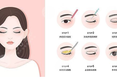  How about double eyelid surgery in Shenzhen Fuhua Medical Beauty Hospital