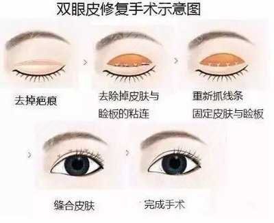 北京延世医疗美容双眼皮修复怎么样