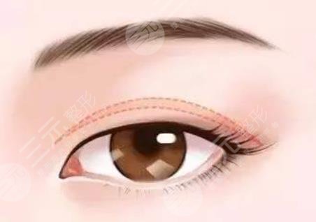  How about the double eyelids of Yiwu Zhang Xiaohong Plastic Hospital