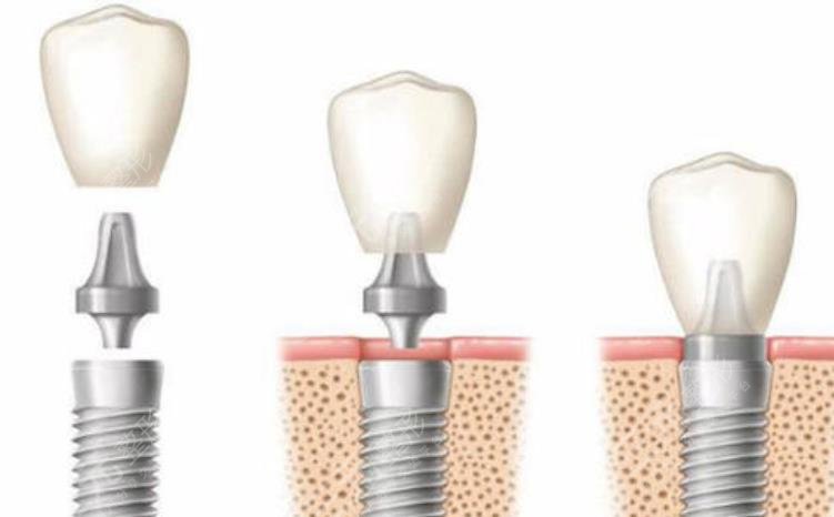  Price List of Implant Teeth in Jinhua Central Hospital