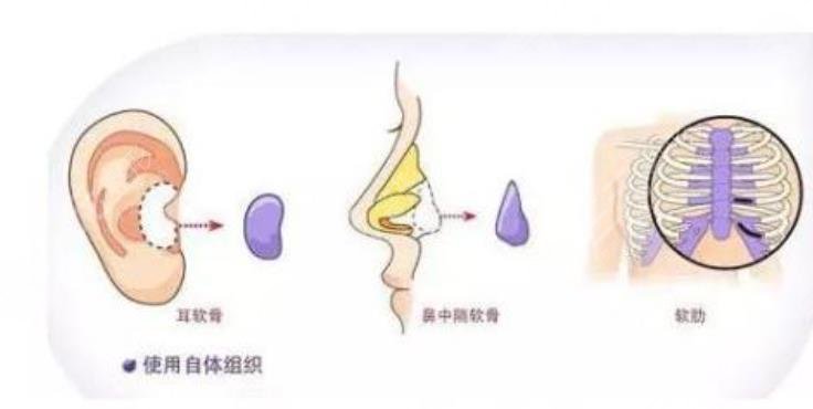 北醫(yī)三院鼻子整形的技術(shù)好不好